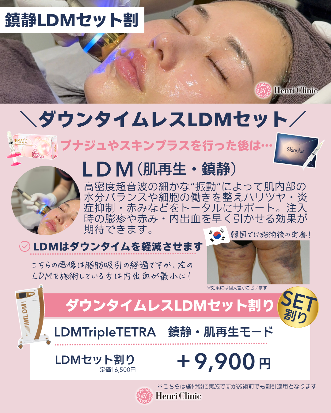 注入後セット割「ダウンタイム軽減LDM」