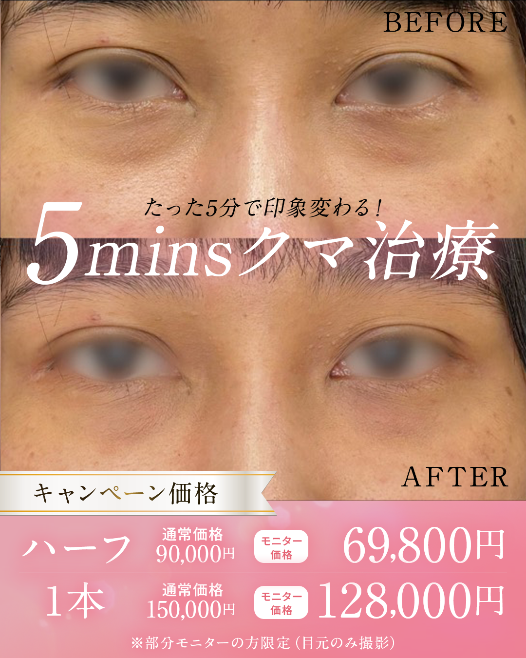 5minsクマ取り注射