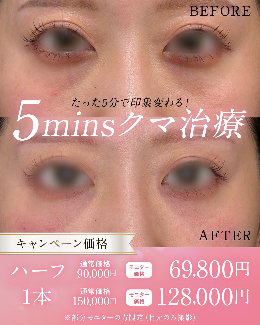 5minutesクマ治療（ベビーコラーゲン）