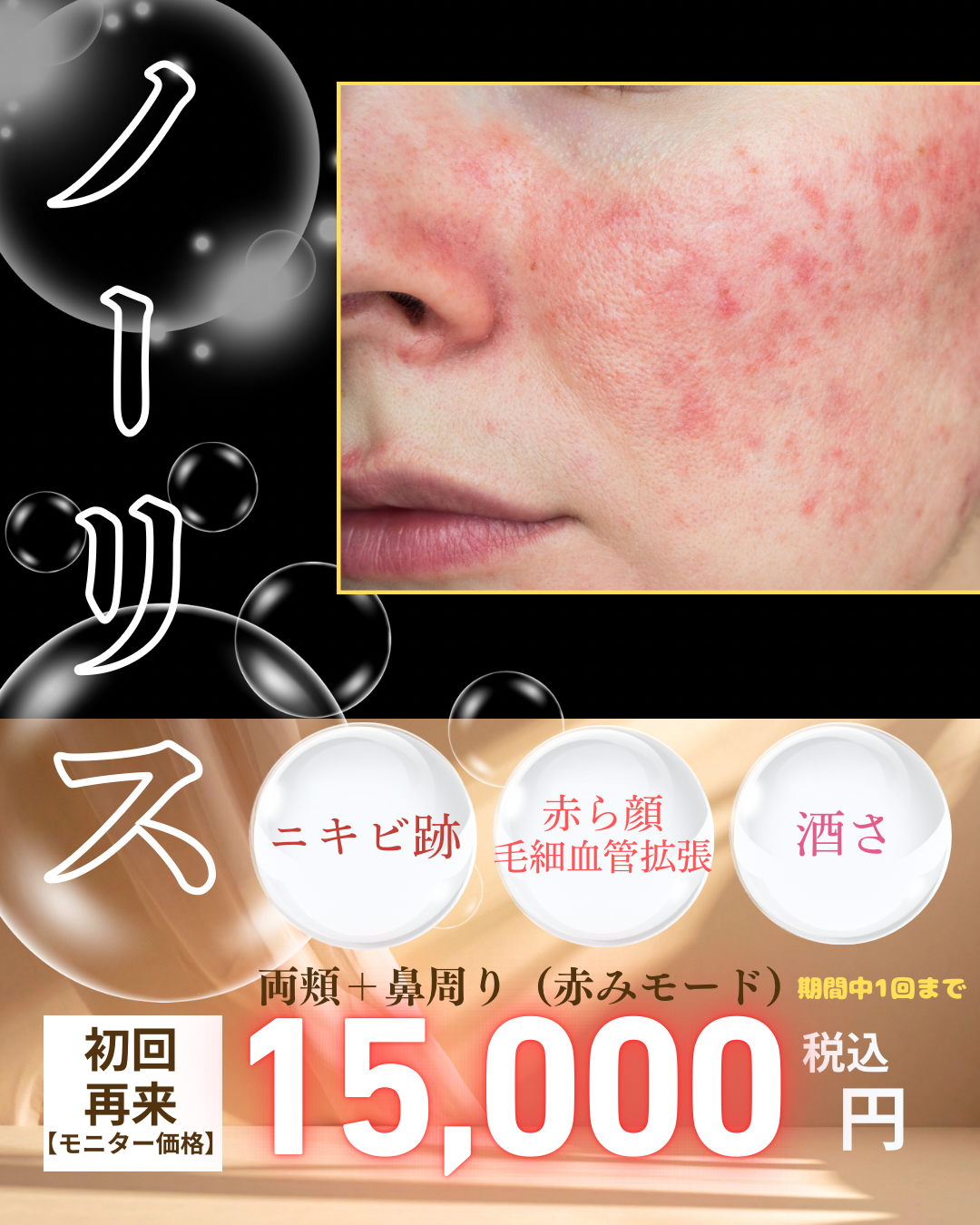 ✸再来 (当院でノーリスご経験がある方)【モニター】ニキビ跡・赤ら顔　両頬+鼻周りセット