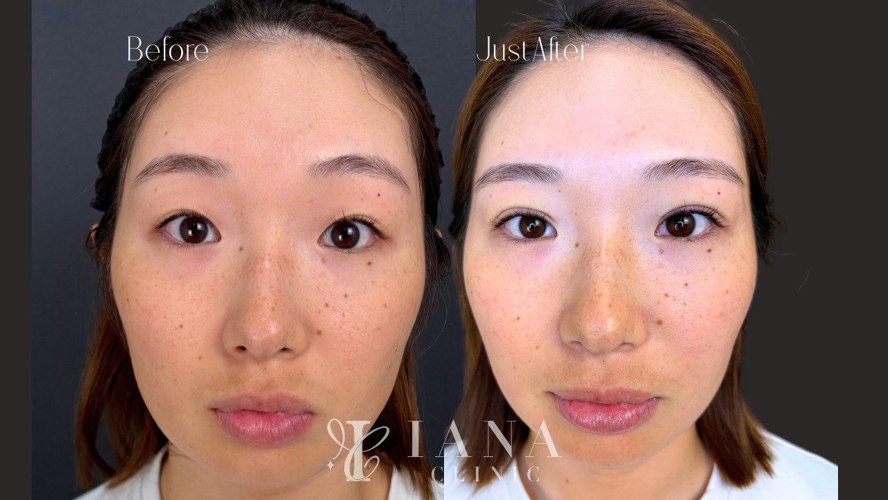 無料カウンセリング（二重整形）