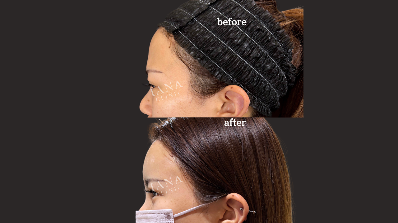 無料カウンセリング（脂肪注入：顔）