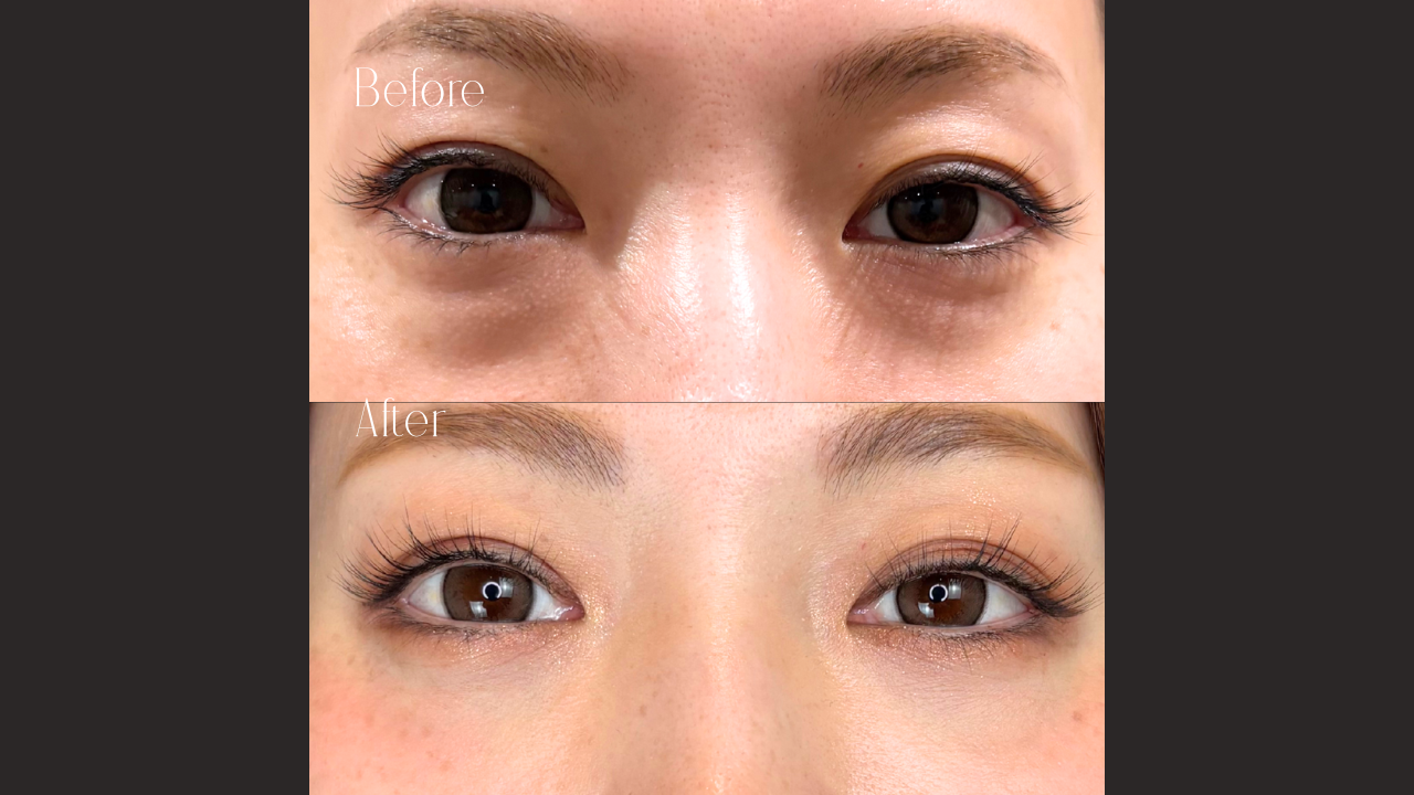 当日施術希望（クマ治療）