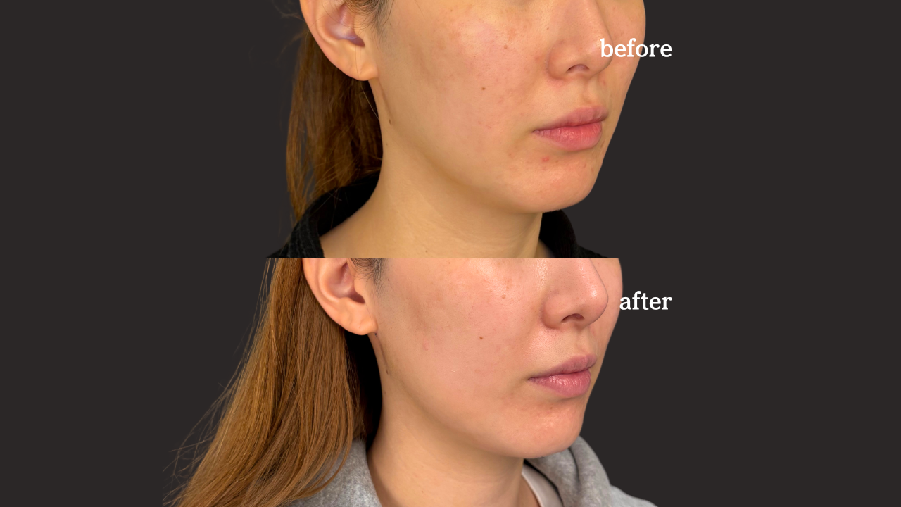 当日施術希望（脂肪吸引：顔）