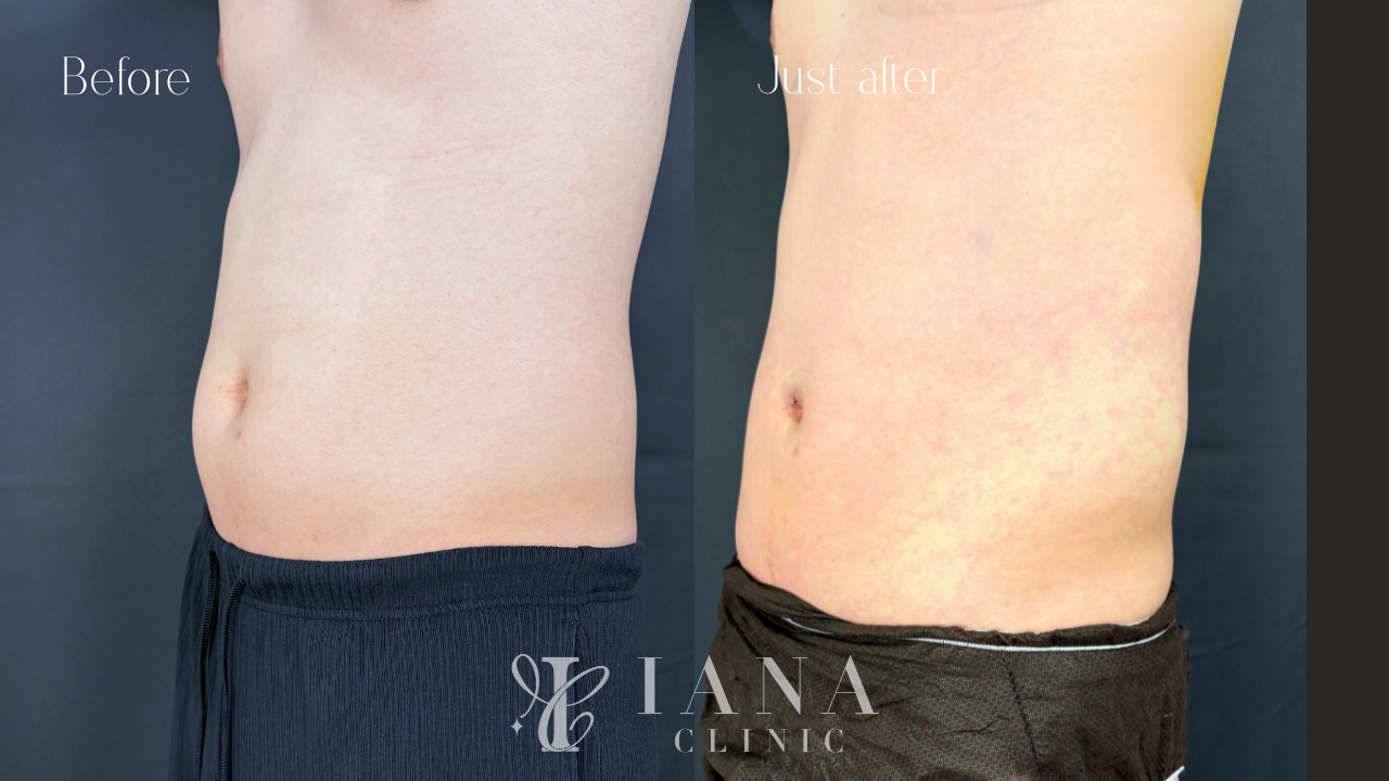 無料カウンセリング（脂肪吸引：お腹・腰）