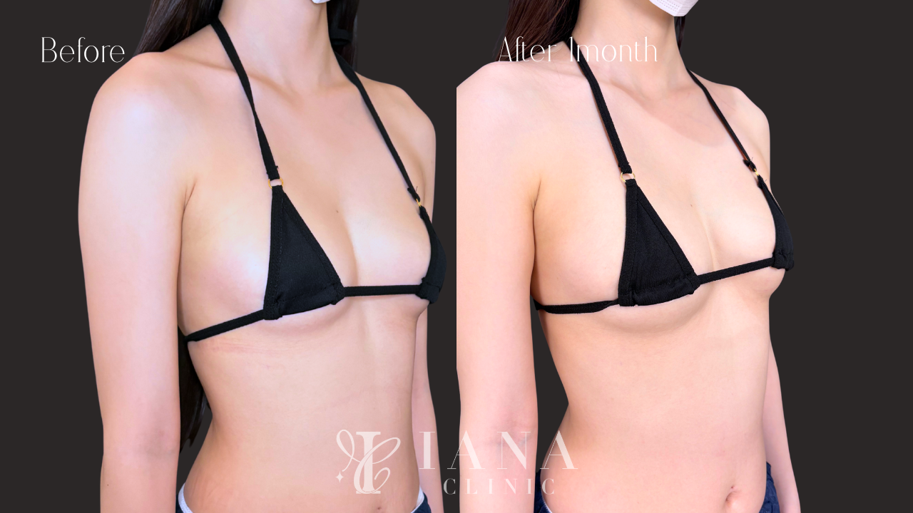 無料カウンセリング（脂肪豊胸）